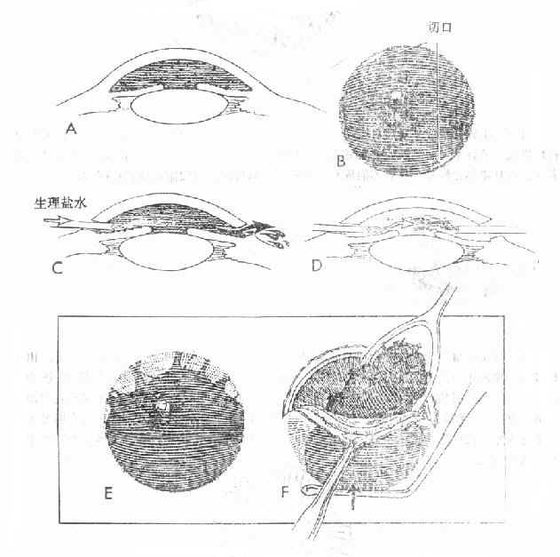 前房积血的手术处理方法