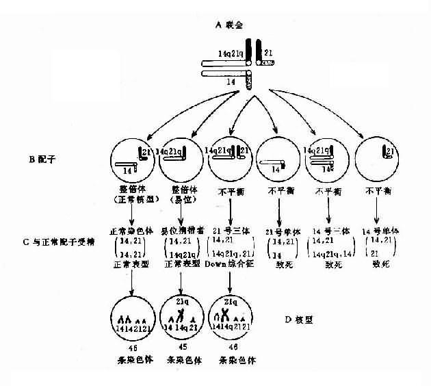 罗氏易位（14q21q）杂合体减数分裂时染色体的联会